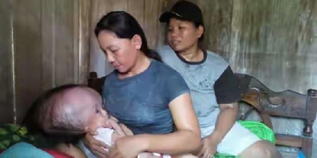 Bayi Penderita Hidrosefalus di Poso Dirawat di rumah karena Tak Punya Biaya