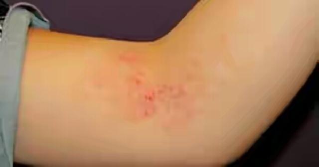 4 Bahan Alami Ini Terbukti Ampuh Untuk Mengatasi Jamur Kulit