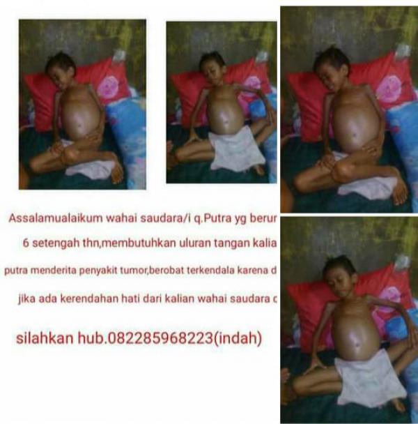 Sungguh Memprihatinkan, Penderita Tumor di Bagansiapiapi Butuh Uluran Tangan Dermawan