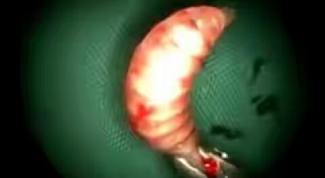 50 Belatung Dikeluarkan dari Hidung Pria Ini