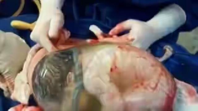 Wow, Jarang Jarang Terjadi, Bayi ini Dilahirkan Masih Dalam Kantung Ketuban. Lihat Seperti ini Video
