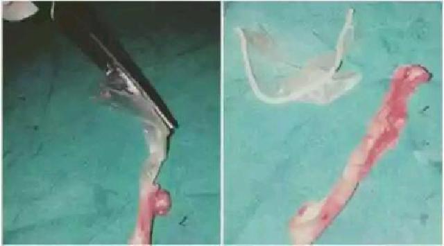 Perempuan Ini Sakit Parah Gara-gara Kondom Terjebak di Usus Bunt