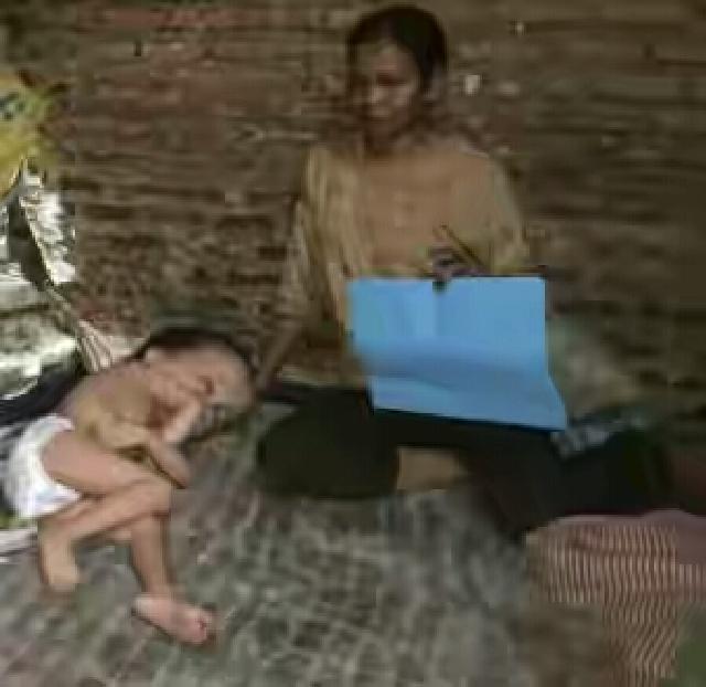 Bayi Zakaria Penderita Hydrocefalus di Pekanbaru Akan Dioperasi