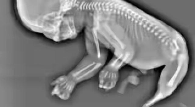 Ibu Ini Terpaksa Aborsi Setelah Tahu Anaknya Bakal Seperti Duyung