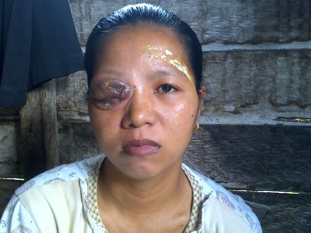 Diagnosa Tumor Retroorbika Mata Kanan, Rusyana Butuh Bantuan Operasi 150 Juta