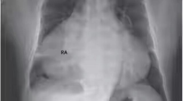 Mengejutkan, Jantung Pria Ini Selebar Dada