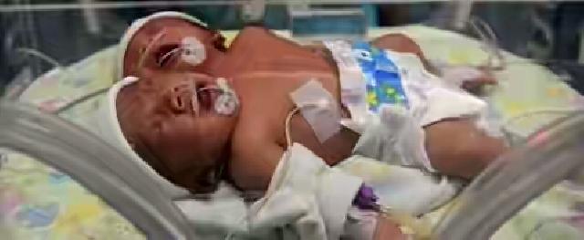 Bayi yang Lahir dengan Dua Kepala di Indonesia Mendapat Perhatian Dunia