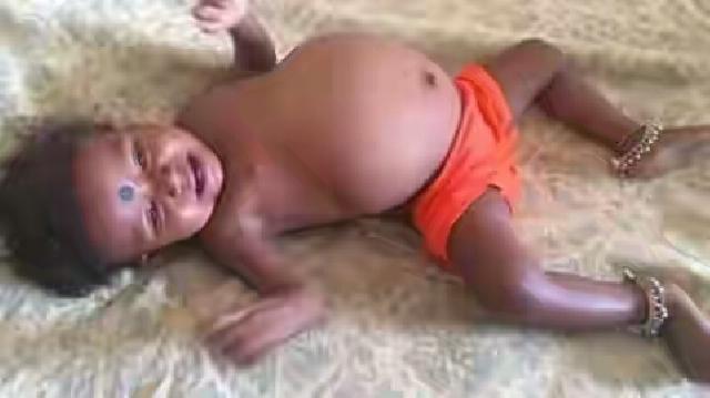 Sosok yang ada di dalam Perut Bocah 15 Bulan Ini Sungguh Mengejutkan.