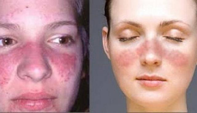 Lima Hal Ini Sebabkan Orang Terserang Penyakit Lupus