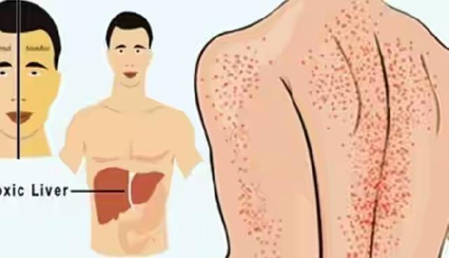 Sepuluh Gejala Liver Anda Bermasalah