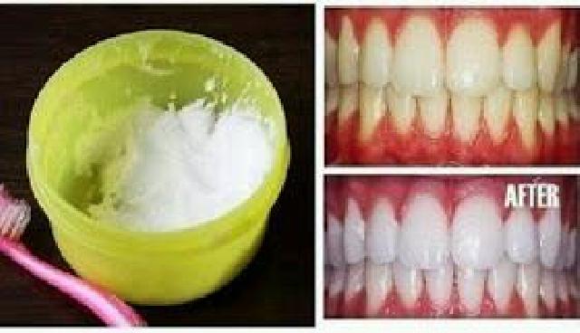 Ini Cara Putih kan Gigi Dalam Sekejab