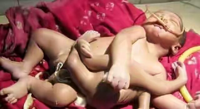 Bayi Berlengan 4 dan Berkaki 4 Ini Dianggap Dewa