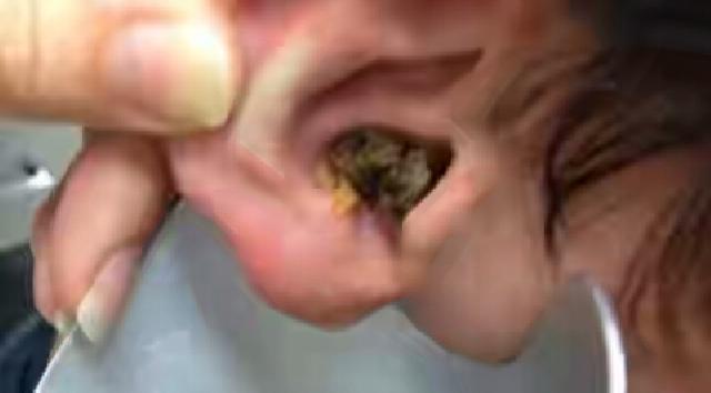 Waduh Ada Kecoa Mati di Telinga Pria Ini