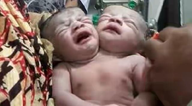 Bayi Berkepala Dua Lahir, Warga Satu Kota Heboh