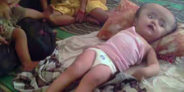 Derita Selly, Bocah 3 Tahun Pengidap Hidrosefalus